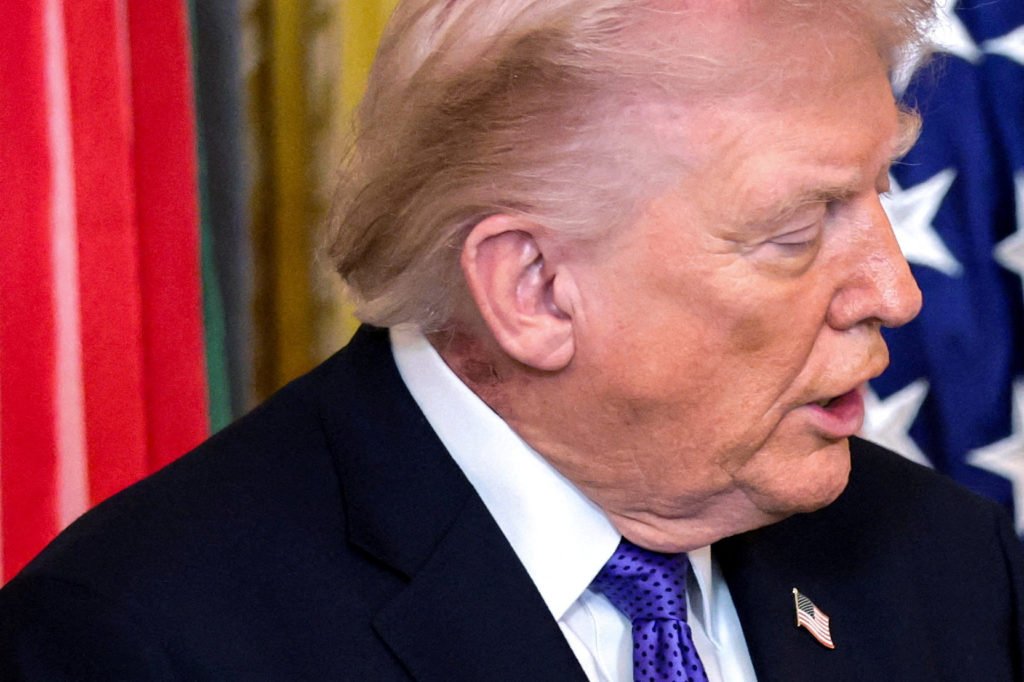 FILE PHOTO: A patch of blemished skin is visible on U.S. President Trump’s neck at the White House in Washington